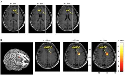 Pain Perception Can Be Modulated by Mindfulness Training: A Resting-State fMRI Study